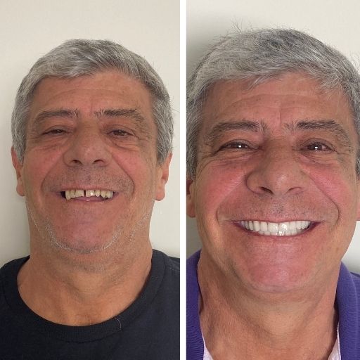 Protocolo sobre implantes